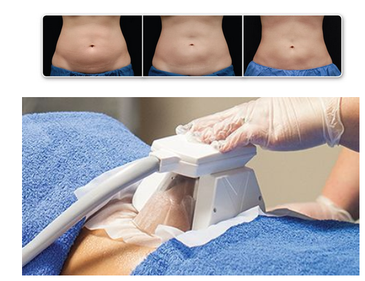 What Is Fat Freezing?