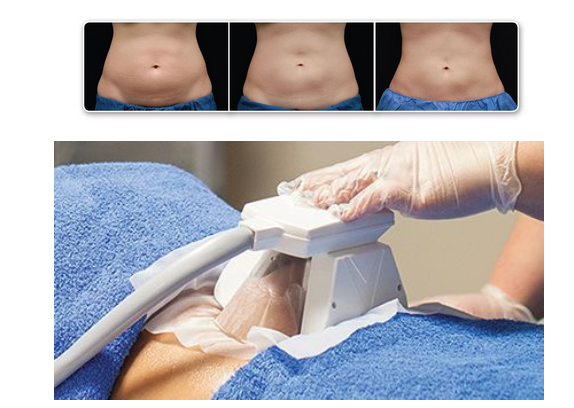 What Is Fat Freezing?